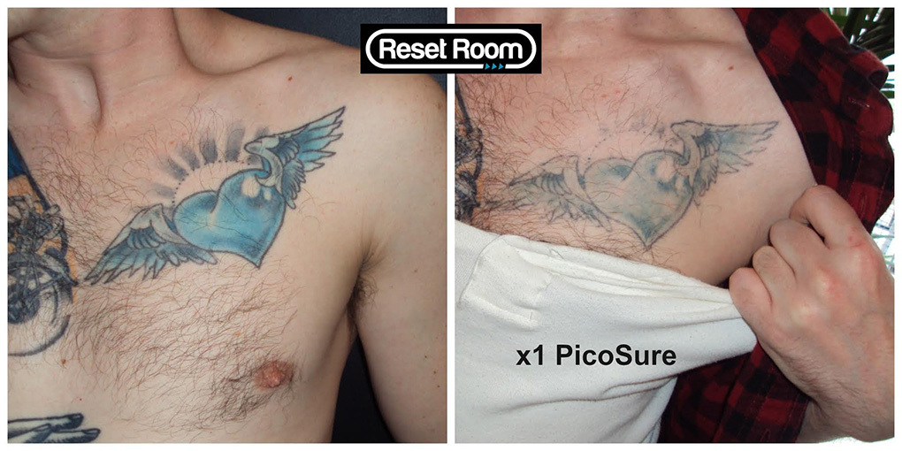 Reset Room - Before and After Photos of Picosure Laser 