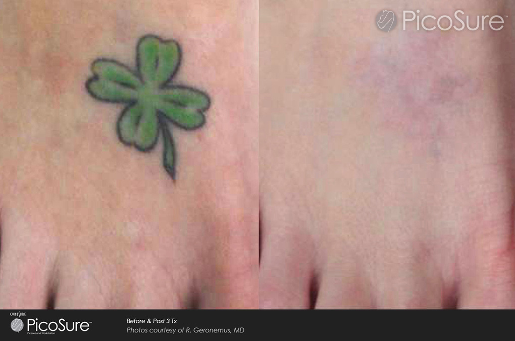 ... Before and After Photos of Picosure Laser Tattoo Removal | Reset Room
