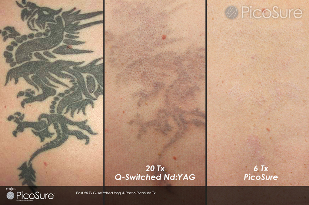 ... Room - About Picosure Laser Tattoo Removal in London | Reset Room