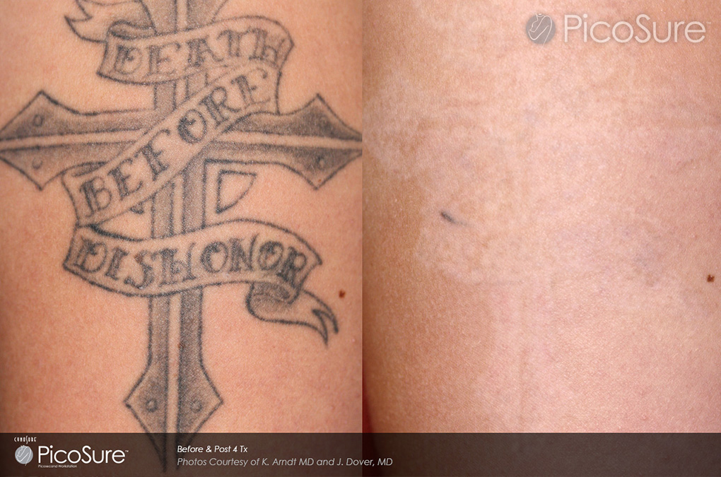... Before and After Photos of Picosure Laser Tattoo Removal | Reset Room