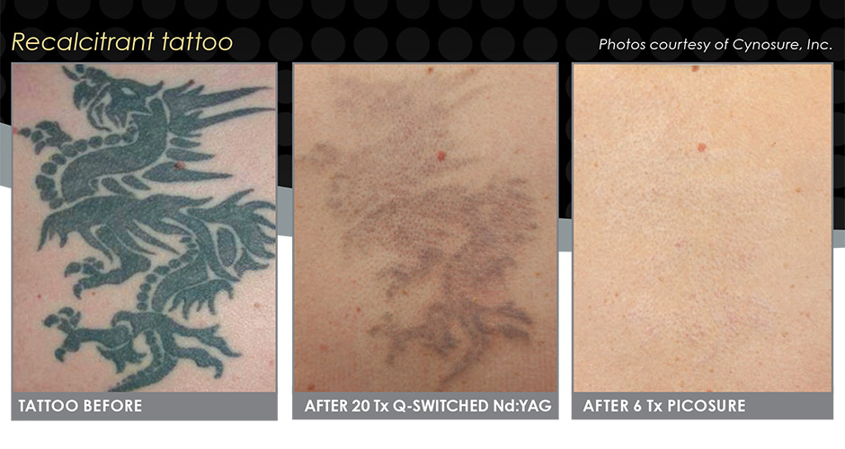 ... - Picosure Laser Tattoo Removal in Soho Central London - Reset Room