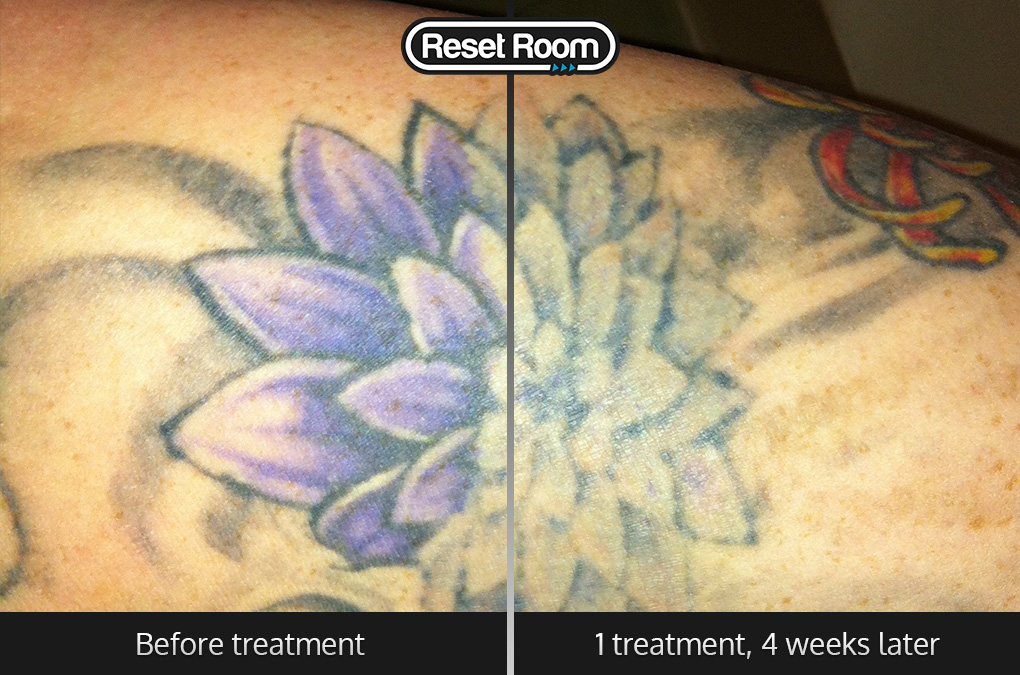... Room - Before and After Photos of Picosure Laser Tattoo Removal