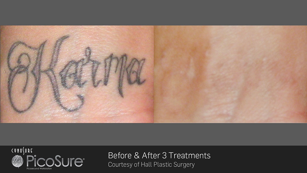 Reset Room - Before &amp; After Photos of Picosure Laser ...