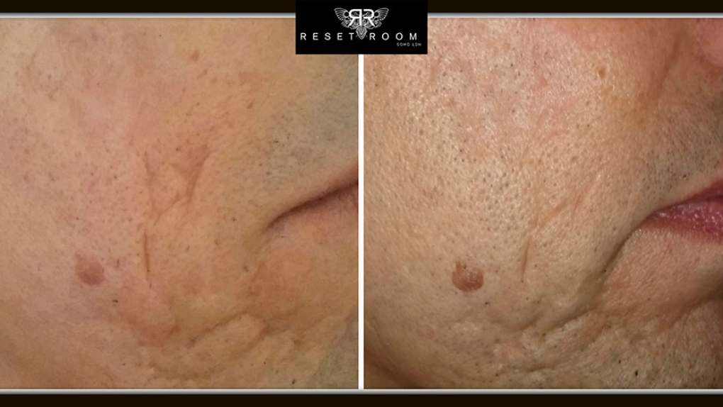 Skin Revitalisation - Reset Room: Laser Tattoo Removal in ...